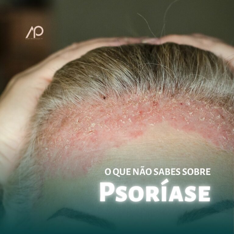 O que não sabes sobre Psoríase